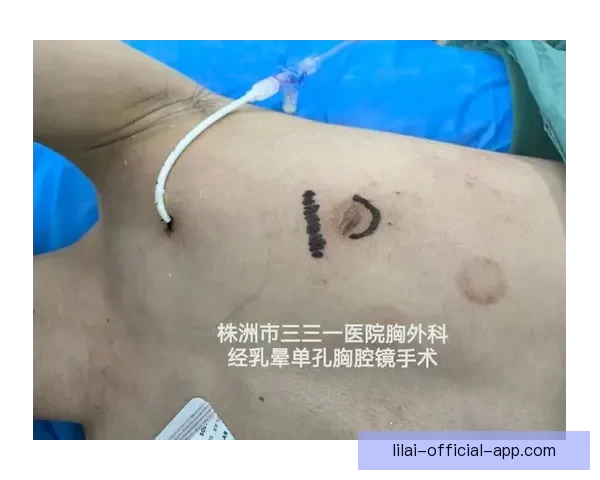 坎宁安气胸康复持续推进 活塞计划一周后复查评估